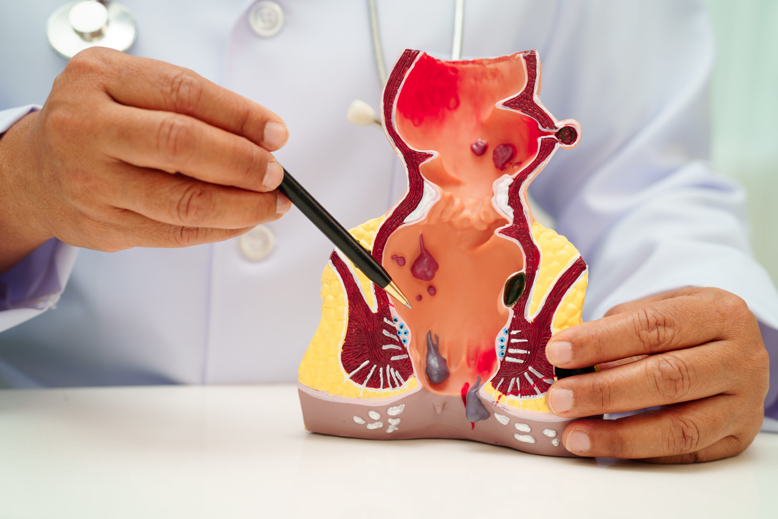 Asian doctor with rectum and hemorrhoid human anatomy model at hospital, inflamed vascular structure.